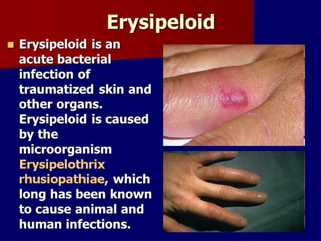 Erysipeloid Erysipeloid is an acute bacterial infection of traumatized skin and other organs. Erysipeloid